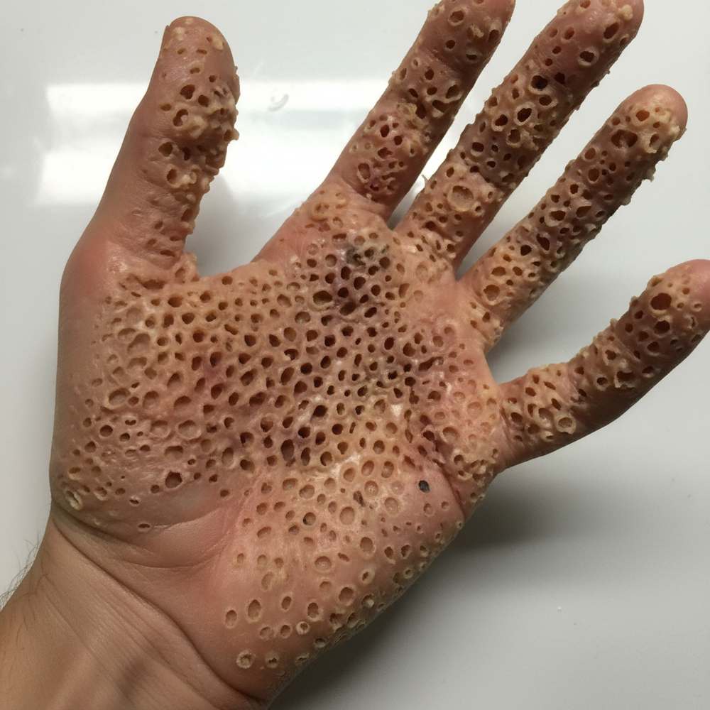 Firefly 集合体恐怖症の画像　人の皮膚に無数の穴 454617